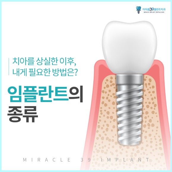 임플란트 종류