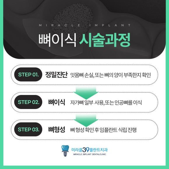 뼈이식 임플란트 시술과정