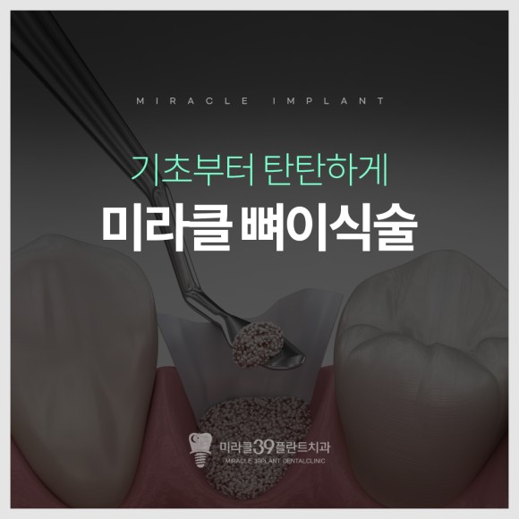 임플란트 뼈이식